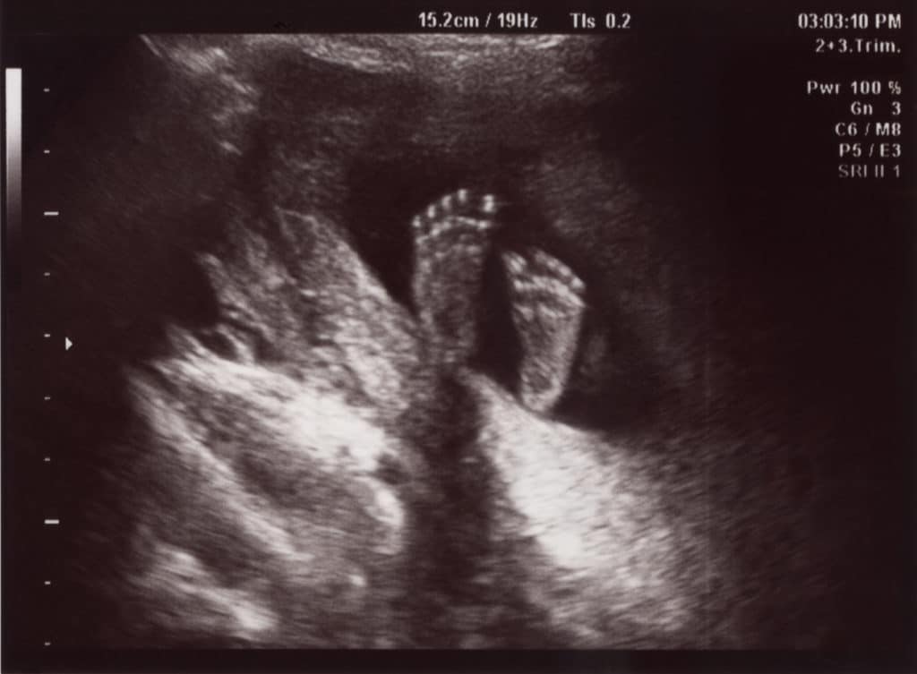 IVF Ultrasound