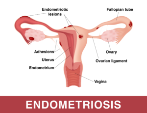 Endometriosis diagram orange county